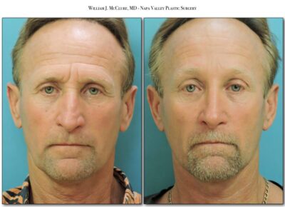 Rhinoplasty – Dr. McClure 5