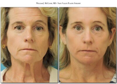 Browlift – Dr. McClure 2