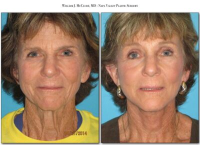 Browlift – Dr. McClure 12