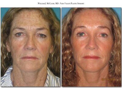 Browlift – Dr. McClure 18