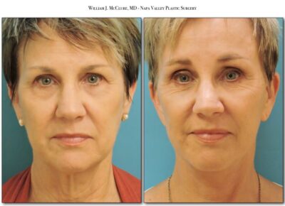 Browlift – Dr. McClure 19