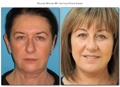 Browlift – Dr. McClure 26