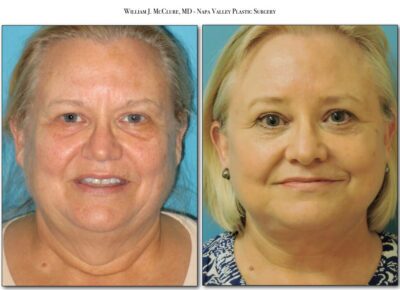Browlift – Dr. McClure 20