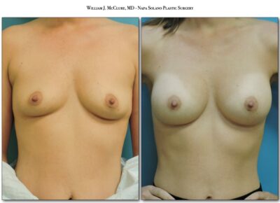 Breast Augmentation – Dr. McClure 3