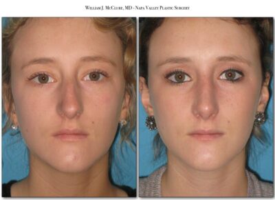 Rhinoplasty – Dr. McClure 4