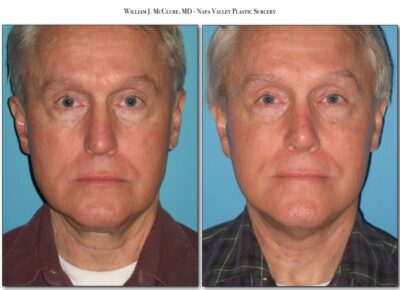 Rhinoplasty – Dr. McClure 9