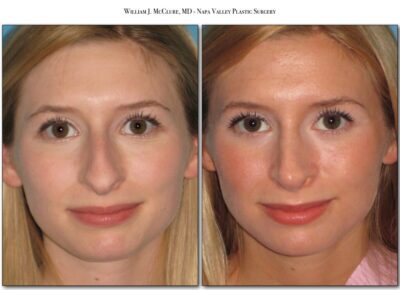 Rhinoplasty – Dr. McClure 10