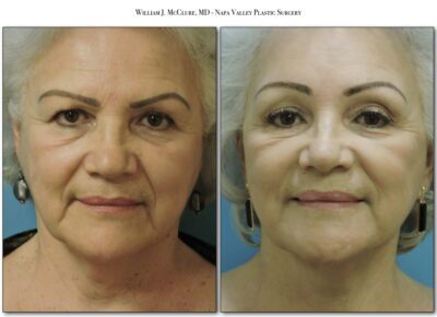Browlift – Dr. McClure 7