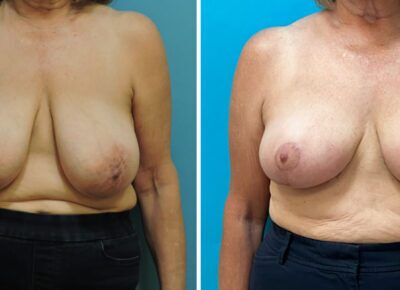 Breast Reduction – Zeiderman 2
