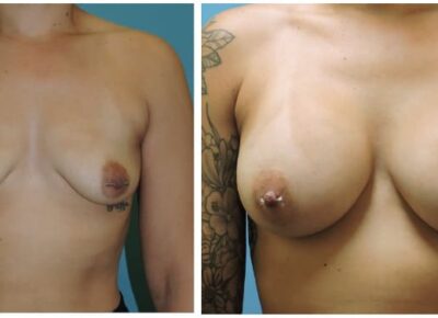 Breast Augmentation Patient – Dr. Snyder Patient 19