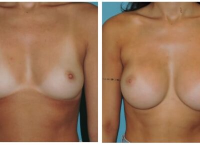 Breast Augmentation – Dr. Snyder Patient 20