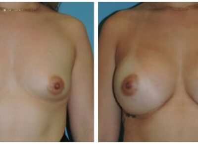 Breast Augmentation – Dr. Snyder Patient 22