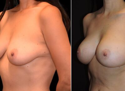 Breast Procedure – Dr Zeiderman Patient 13