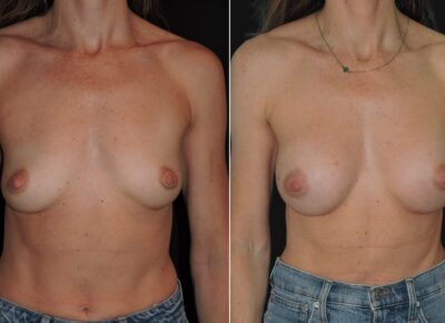 Breast Procedure – Dr Zeiderman Patient 14