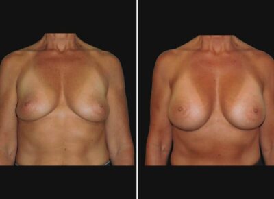 Breast Augmentation – Dr. Zeiderman