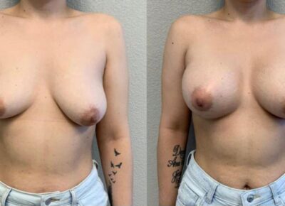 Breast Augmentation Patient 1