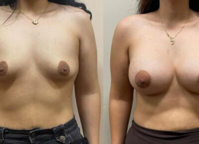 Breast Augmentation Patient 9